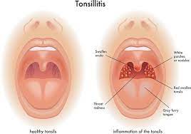 Why when i take it once a day it causes me a dry mouth for 5 hours? Tonsillitis Healthdirect