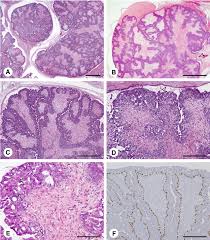 What is a borderline or malignant phyllodes tumour? Juvenile Fibroadenoma With Features Of Phyllodes Tumor Showing Intraductal Growth And Prominent Epithelial Hyperplasia In An 11 Year Old Girl Sciencedirect