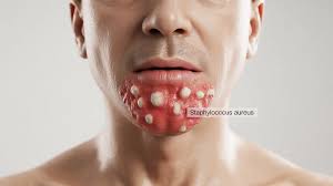 Image result for Strep throat infection roof of mouth