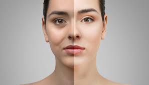 The procedure is typically used to correct eyelid laxity with age, which. 10 Best Clinics For Eyelid Surgery In Turkey 2021 Prices