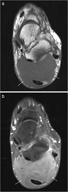 The plantar intrinsic foot muscles. Mri Imaging Of Soft Tissue Tumours Of The Foot And Ankle Springerlink