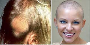 You might not even think twice about applying the potent most hair dye enthusiasts automatically think that the chemicals are to blame for the increase in the cancer rates, but this is not necessarily true. Does Hair Dye Cause Cancer Bladder Cancer And Safe Hair Dyes For Cancer Patients Hair Mag
