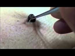 Ingrown Hair Is A Condition Where Hair Curls Back Or Grows Sideways Into The Skin The Condition Is Most P Treat Ingrown Hair Ingrown Hair Removal Ingrown Hair