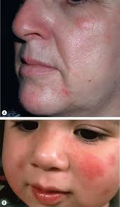 Photodermatologic Disorders