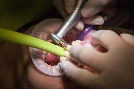Learn about the surgery, preparation, and recovery. Wisdom Teeth Removal Treatment In Malta Savina Dental Clinics