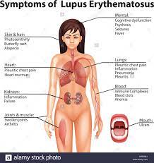 Last ned alle bilder og bruk dem for selv kommersielle prosjekter. Lupus Erythematodes Stockfotos Und Bilder Kaufen Alamy