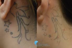 Maybe you got your tattoo the day you turned eighteen. Pin On Tattoo Removal