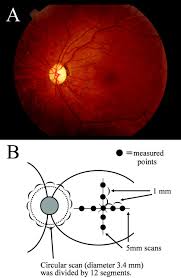 Breakthrough In Treating Mitochondrial Eye Disease Including Dominant Optic Atrophy A Hereditary Eye Diseas Neuropathy Treatment Mitochondrial Science Journal