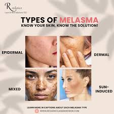 Image result for Melasma