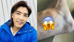 Mike He Shares Photo Of “Super Painful” Ankle Injury Caused By Shoe Spike;  Says He “Can't Stop” The Bleeding