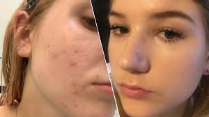 Accutane is not for the mild to moderate acne. Accutane Side Effects 9 Things To Know About The Acne Treatment Glamour