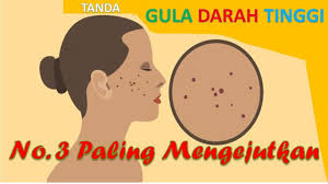 Assamualaikum ,.hipertensi atau tekanan darah tinggi adalah penyakit senyap yang boleh membawa kepada komplikasi dan juga kematian jika tidak dirawat.tanda. Inilah 5 Tanda Gula Darah Tinggi Nomor 3 Paling Mengejutkan Youtube
