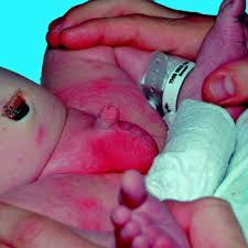 Image result for Neonatal Circumcision