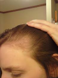 All you need to do is to support your scalp with exotic ayurvedic herbal remedies, diet, and lifestyle, which rapidly brings your hair growth to the normal state. Postpartum Hairloss Journey For My Baby