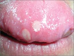 Image result for mouth ulcer on tongue)