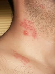 An outbreak of herpes in the face. Shingles Wikipedia