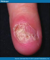 Nail Disorders In Children