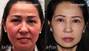 This procedure, called a brow lift, involves making incisions into the scalp and tightening the skin to lift the eyebrows. Upper Eye Lift Surgery