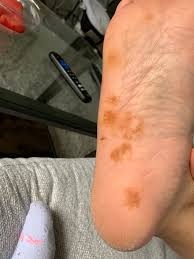 Image result for brown patches on the feet
