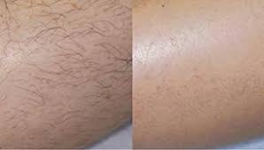 Safe, effective laser hair removal. Nyxsb0izustapm