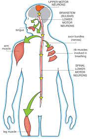 Als Signs And Symptoms Motor Neuron Neurons Motor Neuron Disease Treatment