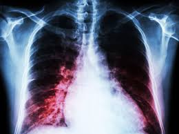 Image result for lung cancer xray