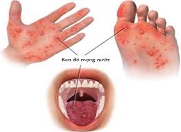 Truyền thông phòng, chống bệnh Tay - Chân - Miệng