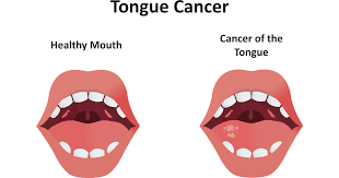 Image result for cancer tongue symptoms)
