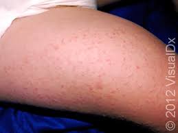 Image result for Keratosis pilaris