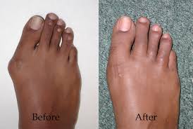 With claw toe, an individual's toes are bent into a exercises for curled toes. Hammertoe Surgery Arches Foot Institute Surprise Az Podiatrist Surprise Az Foot Doctor
