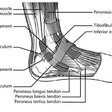 The tear is repaired with suture above. Pdf Peroneal Tendon Disorders