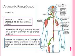 Esclerosis lateral amiotrófica esclerosis lateral amiotróficaclasificación y recursos externos aviso médico. Esclerosis Lateral Amiotrofica