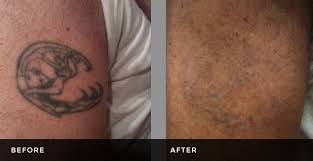 Looking for the best tattoo removal in usa and overwhelmed by the options? Before After Tri County Laser Center