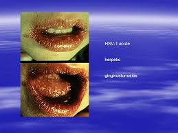 Both cause sores along with a few other symptoms. H S V Ppt Video Online Download