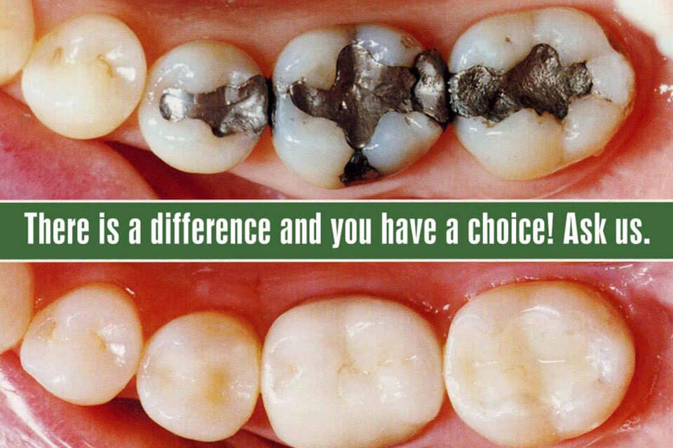 Cosmetic fillings product image