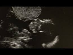 My Baby May Have Down Syndrome Trisomy 18 20 Week Ultrasound Anatomy Scan 5 10 16 Youtube