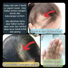 Hal ini disebabkan oleh pelbagai punca seperti hormon, penuaan, stress dan banyak lagi. Kisahnya Selepas Bersalin Rambut Faith Fleur Kota Bharu Facebook