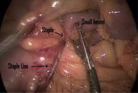 In thinner areas of your stomach your surgeon may choose a staple that closes to 2.0 mm. Staple Line As A Cause Of Unusual Early Internal Hernia After Appendectomy Sciencedirect
