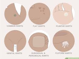 5 ways to get rid of warts wikihow