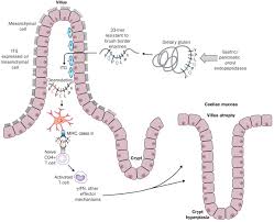 Coeliac Disease A Meeting Point For Genetics Immunology And Protein Chemistry The Lancet