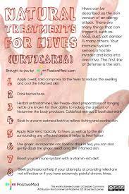Pin By Cj On Health N Fitness Home Remedies For Hives Hives Remedies Treatment For Hives