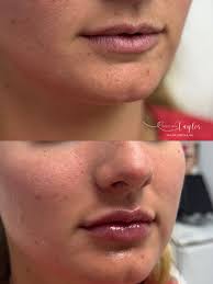 This beauty is getting married in October and wanted to start small. I used  half of a syringe of Evolysse Form for some plump and hydration! We both  LOVED her results and