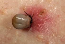 Tick Bite: Pictures, Symptoms, When to Be Concerned