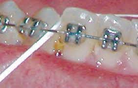 Dental biofilm naturally occurs in our mouths so there's nothing you can do to get rid of teeth plaque completely or stop it building up every day. Life With Braces In San Tan Valley Az Peterson Family Orthodontics