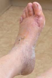 Beyond Bunionectomy; The Role Of Physical Therapy | Lower Extremity Review  Magazine