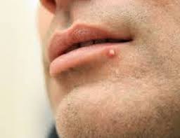 Hold a cold compress on your pimple for a minute or two twice a day. How Acne On Your Face Can Express About Your Health Ethicare Remedies