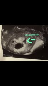 Hematoma En El Embarazo Club De Bebes Agosto 2018 Babycenter