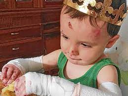 Siete Ninos De Manabi Tienen Piel De Mariposa El Diario Ecuador