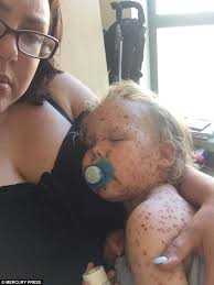 What Jasper Allen's 'worst case of chickenpox' reveals about GPs' surgeries 