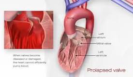 Image result for icd 10 code for mitral prolapse
